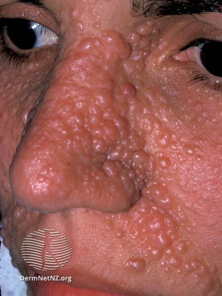 File:Multiple angiofibromas on the nose and face of a child. (DermNet NZ facial-angiofibromas-15).jpg
