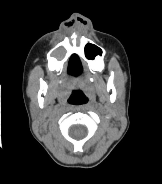 File:Nasoorbitoethmoid fracture (Radiopaedia 90044-107205 Axial non-contrast 100).jpg