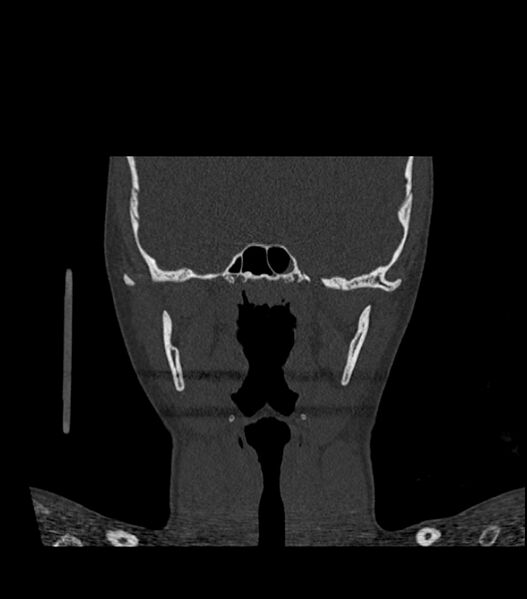 File:Nasoorbitoethmoid fracture (Radiopaedia 90044-107205 Coronal bone window 82).jpg