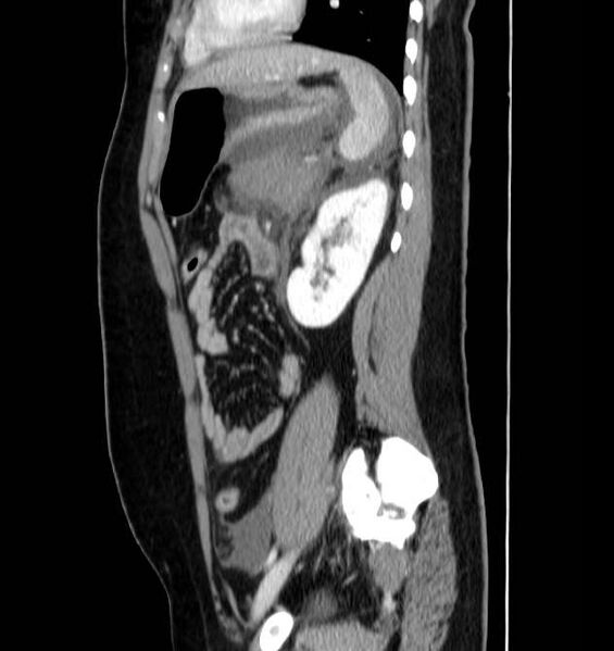 File:Necrotizing pancreatitis (Radiopaedia 23001-23031 C 57).jpg