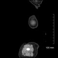 Neonatal neuroblastoma (Radiopaedia 56651-63438 C 10).jpg