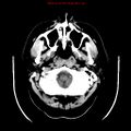 Neuroglial cyst (Radiopaedia 10713-11185 Axial non-contrast 30).jpg