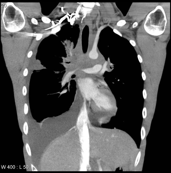 File:Non-Hodgkin lymphoma involving lung (Radiopaedia 29094-29470 C 14).jpg