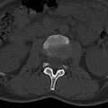 Normal CT lumbar spine (Radiopaedia 53981-60118 Axial bone window 29).jpg