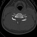 Normal CT of the cervical spine (Radiopaedia 53322-59305 Axial bone window 159).jpg
