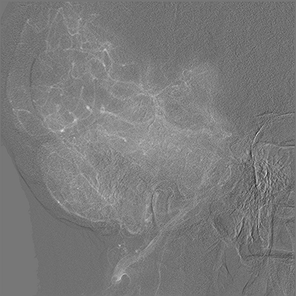 File:Normal cerebral angiogram (four vessel DSA) (Radiopaedia 41708-44649 O 13).png
