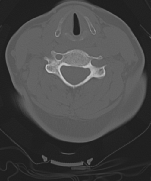 File:Normal cervical spine MRI (including Dixon) (Radiopaedia 42762-45926 Axial bone window 33).png