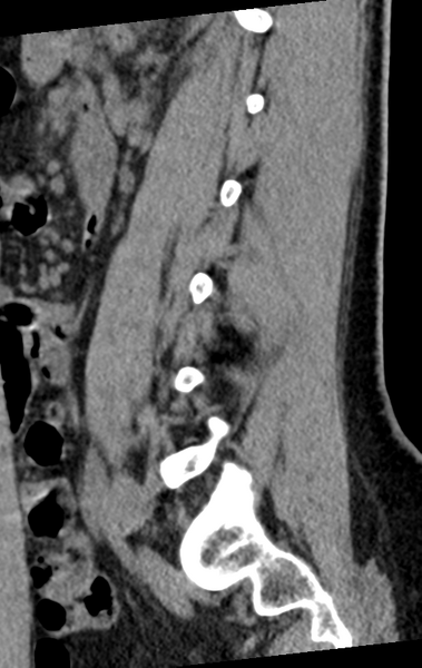 File:Normal lumbar spine CT (Radiopaedia 46533-50986 C 34).png