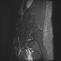 Normal lumbar spine MRI (Radiopaedia 47857-52609 Sagittal STIR 1).jpg