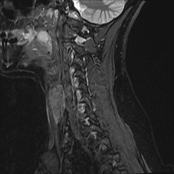 File:Normal trauma cervical spine MRI (Radiopaedia 32130-33071 Sagittal STIR 13).jpg