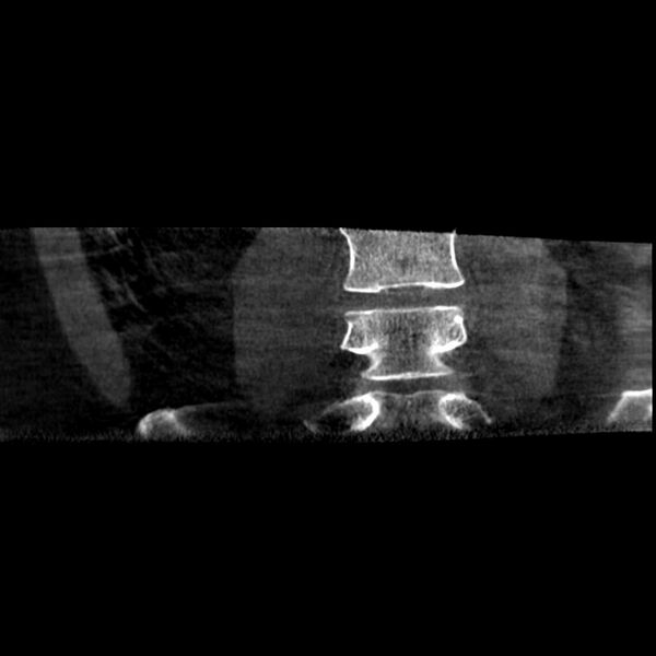 File:Oblique sublaminar lumbar puncture (Radiopaedia 90103-107350 Coronal non-contrast 2).jpeg