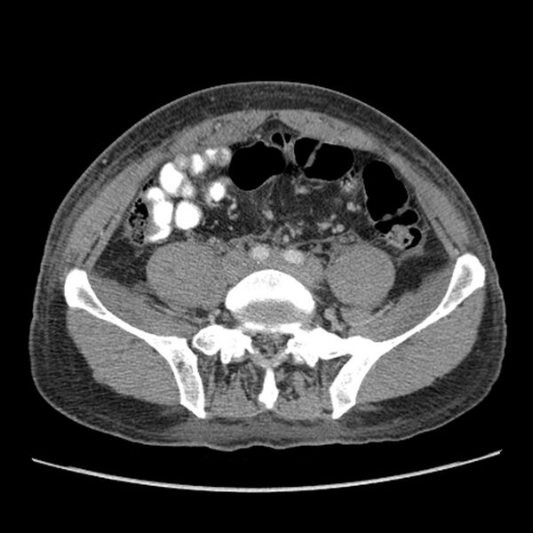 File:Obstructive bladder transitional cell carcinoma (Radiopaedia 9825-10410 A 20).jpg