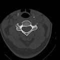 Occipital condyle fracture (Radiopaedia 31755-32691 Axial bone window 31).jpg