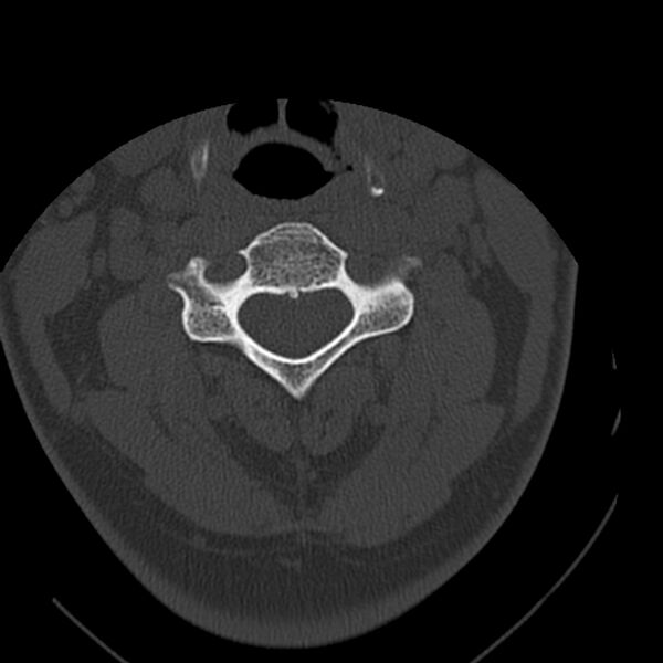 File:Occipital condyle fracture (Radiopaedia 31755-32691 Axial bone window 31).jpg
