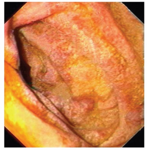 Mucosa is swollen and grey-yellowish