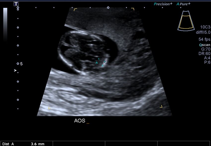 1st trimester nuchal-morphology ultrasound (Radiopaedia 44706-48477 General anatomy and NT 12).jpg