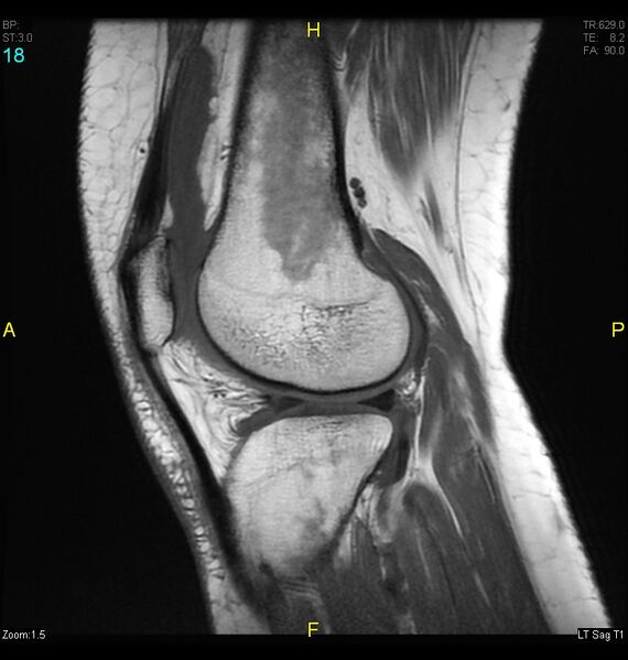 File:ACL mucoid degeration with cystic changes (Radiopaedia 48428-53341 Sagittal T1 16).jpg