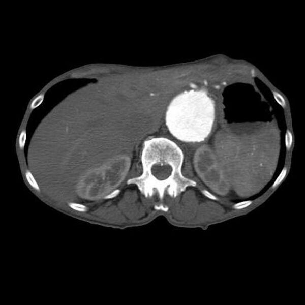 File:Abdominal aortic aneurysm (Radiopaedia 11150).jpeg