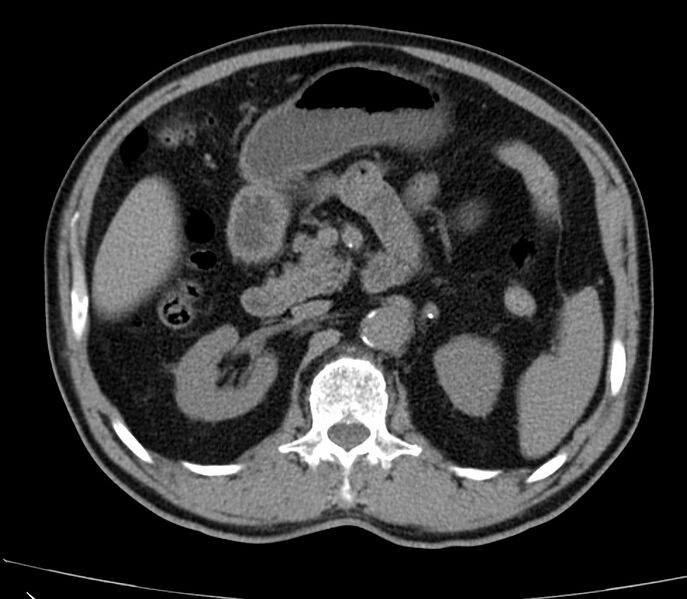 File:Abdominal aortic aneurysm (Radiopaedia 22421-22458 non-contrast 19).jpg