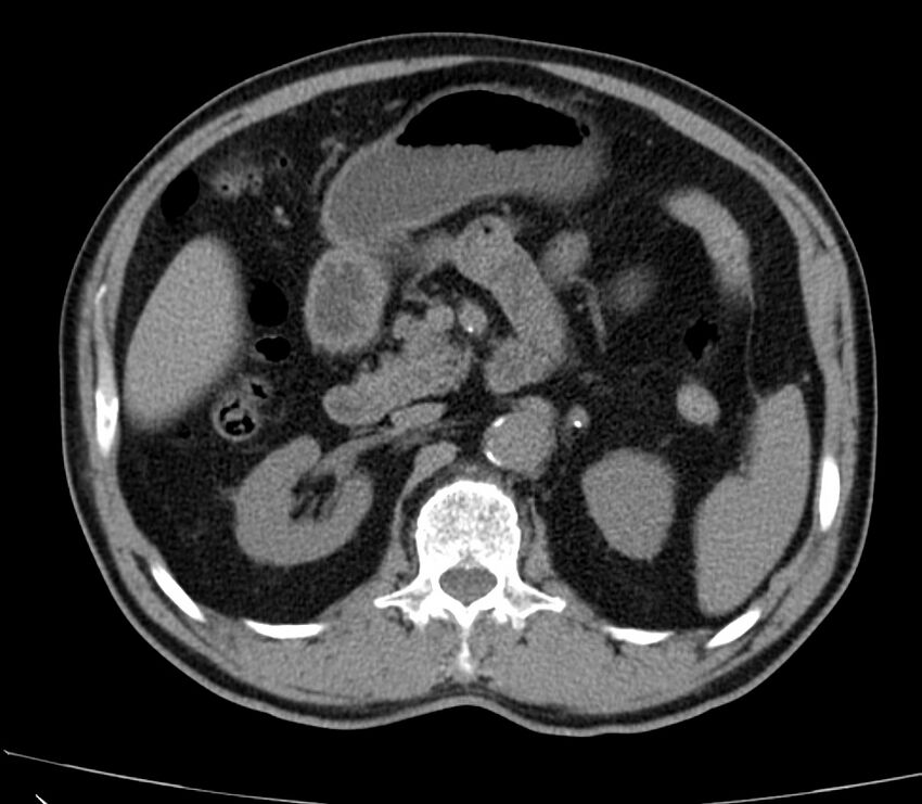 Abdominal aortic aneurysm (Radiopaedia 22421-22458 non-contrast 19).jpg