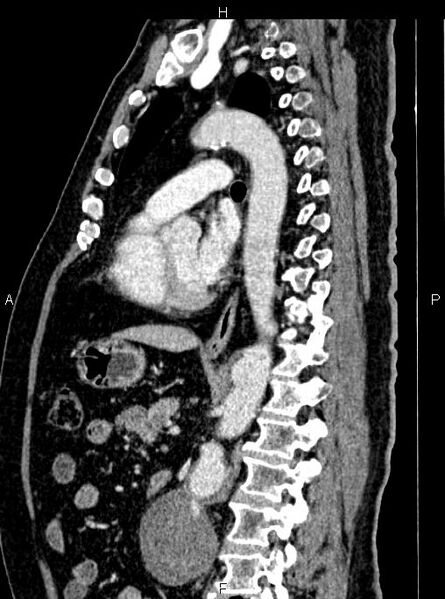 File:Abdominal aortic aneurysm (Radiopaedia 83094-97462 Sagittal renal cortical phase 71).jpg