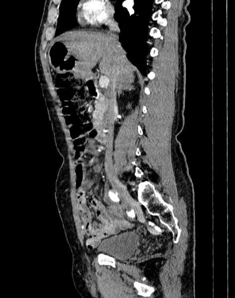 File:Abdominal aortic aneurysm (Radiopaedia 83581-98689 Sagittal C+ arterial phase 21).jpg