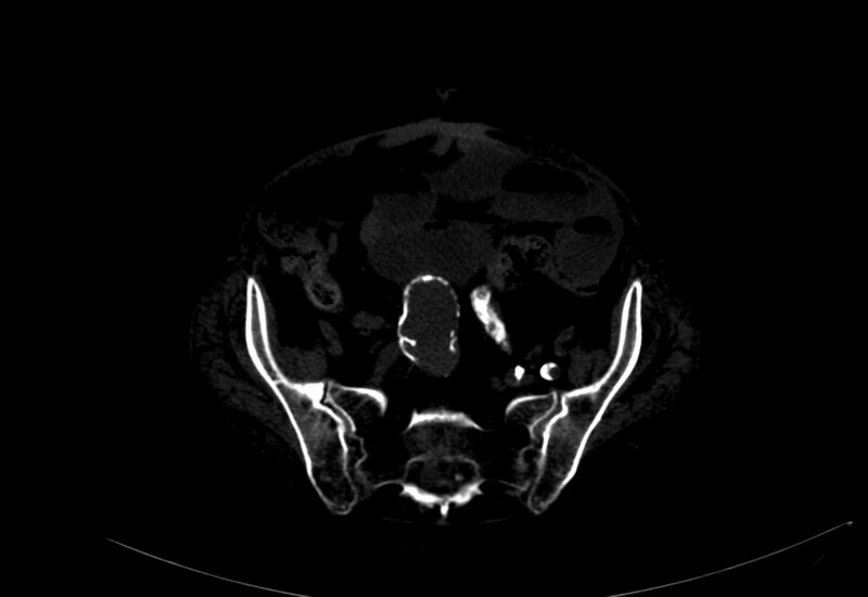 File:Abdominal aortic aneurysm - impending rupture (Radiopaedia 19233-19246 B 45).jpg