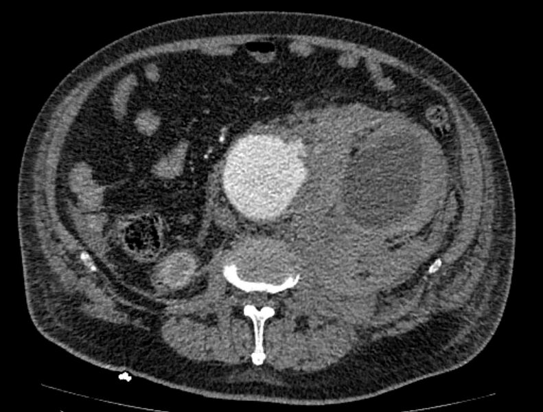 File:Abdominal aortic aneurysm rupture (Radiopaedia 54179-60362 Axial C+ arterial phase 33).jpg
