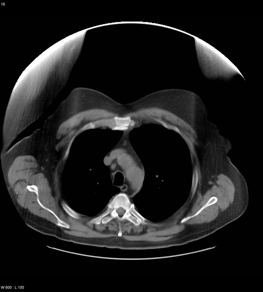Abdominal aortic aneurysm with intramural hematoma then rupture (Radiopaedia 50278-55631 Axial non-contrast 12).jpg