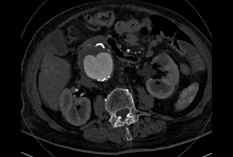 File:Abdominal aortic aneurysm with thrombus fissuration (Radiopaedia 73192-83919 Axial C+ arterial phase 75).jpg