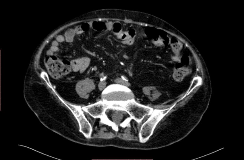 Abdominal aortic interposition tube graft and aneurysm thrombosis (Radiopaedia 71438-81857 Axial C+ arterial phase 141).jpg