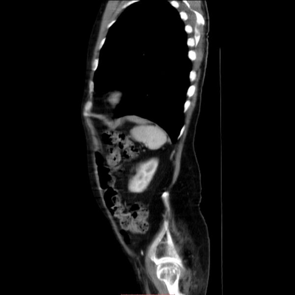 File:Abdominal aortic interposition tube graft and aneurysm thrombosis (Radiopaedia 71438-81857 Sagittal C+ arterial phase 4).jpg