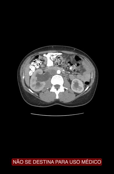 File:Abdominal desmoid tumor (Radiopaedia 44024-47540 Axial C+ arterial phase 9).jpg