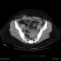 Abdominal wall endometriosis (Radiopaedia 25723-25885 Axial C+ portal venous phase 29).jpg