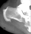 Achilles and plantar fascia enthesopathy (Radiopaedia 49001).jpg