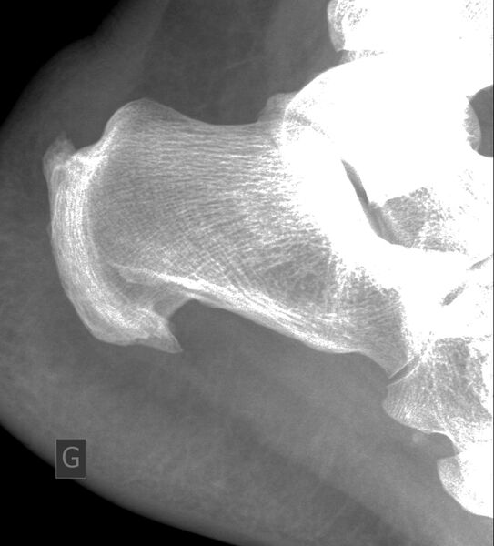 File:Achilles and plantar fascia enthesopathy (Radiopaedia 49001).jpg