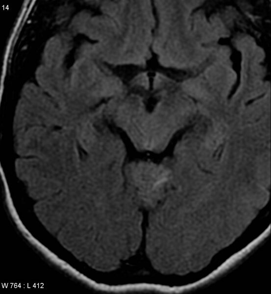 File:Acoustic schwannoma (large with cystic change) (Radiopaedia 5369-7130 Axial FLAIR 8).jpg