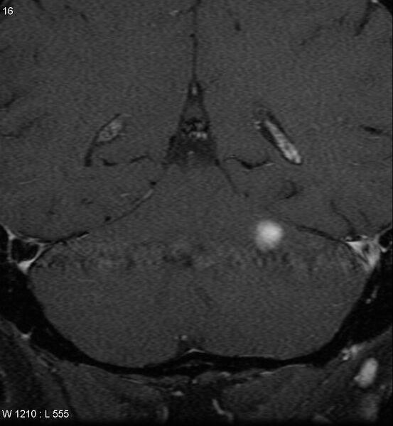 File:Acoustic schwannoma (large with cystic change) (Radiopaedia 5369-7130 Coronal T1 C+ fat sat 13).jpg
