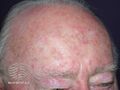 Actinic keratoses (DermNet NZ lesions-sk6).jpg