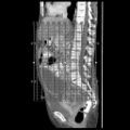 Actinomycosis related to longstanding IUD (Radiopaedia 77303-89380 Coronal C+ portal venous phase 1).jpg