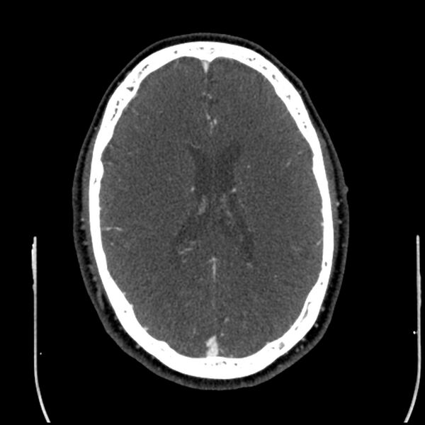 File:Acute A3 occlusion with ACA ischemic penumbra (CT perfusion) (Radiopaedia 72036-82527 Axial C+ arterial phase thins 41).jpg