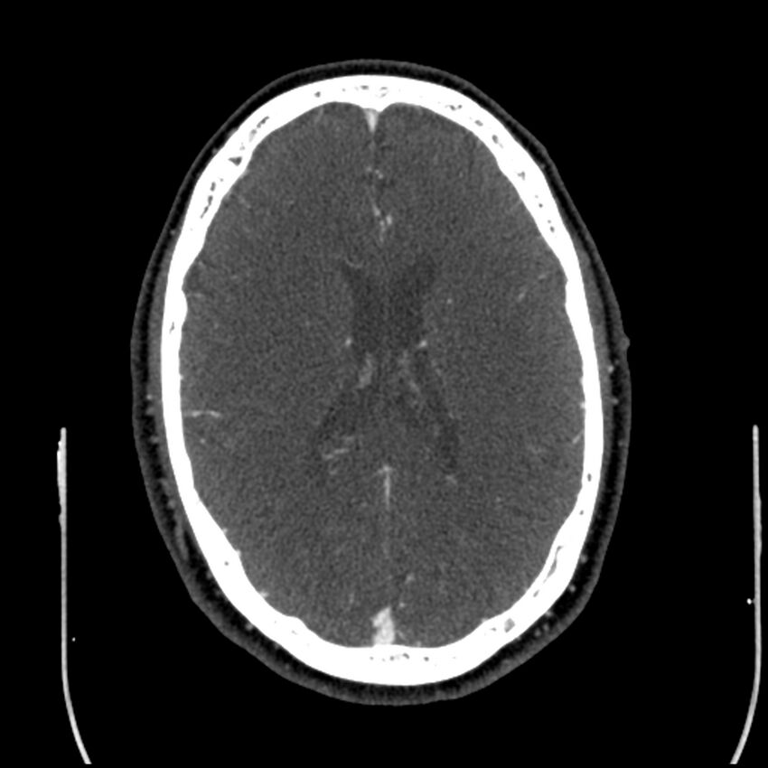 Acute A3 occlusion with ACA ischemic penumbra (CT perfusion) (Radiopaedia 72036-82527 Axial C+ arterial phase thins 41).jpg