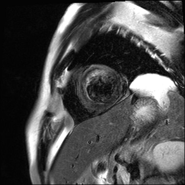 File:Acute anteroseptal myocardial infarction (Radiopaedia 68409-77947 Short axis T2 2).jpg