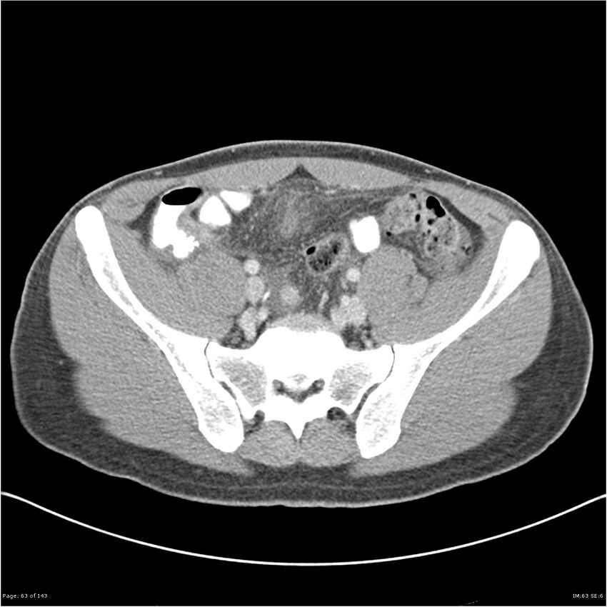 Acute appendicitis (Radiopaedia 25364-25615 B 53).jpg