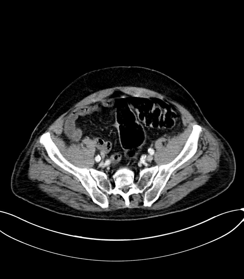 Acute arterial mesenteric ischemia (Radiopaedia 78238-90828 Axial C+ portal venous phase 112).jpg