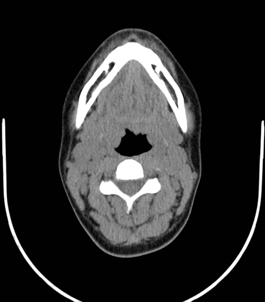 File:Acute bacterial tonsillitis (Radiopaedia 22882-22908 Axial non-contrast 26).png