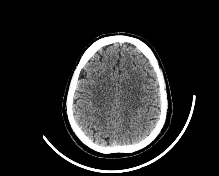 File:Acute cerebral infarct (Radiopaedia 35604-37123 Axial non-contrast 74).jpg