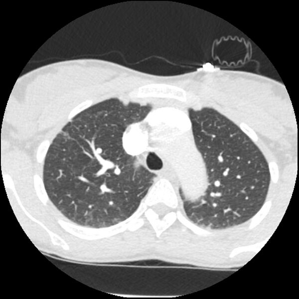 File:Acute chest syndrome - sickle cell disease (Radiopaedia 42375-45499 Axial lung window 56).jpg