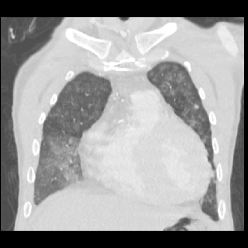 Acute diffuse alveolar hemorrhage (Radiopaedia 41323-44158 Coronal lung window 9).jpg