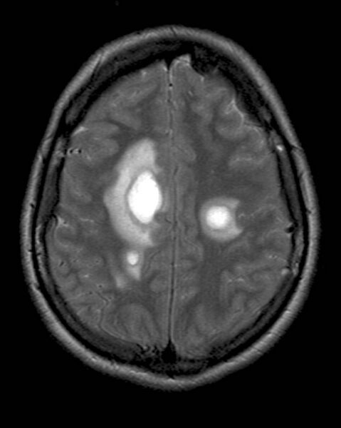 File:Acute disseminated encephalomyelitis (Radiopaedia 2576-6271 Axial T2 1).jpg